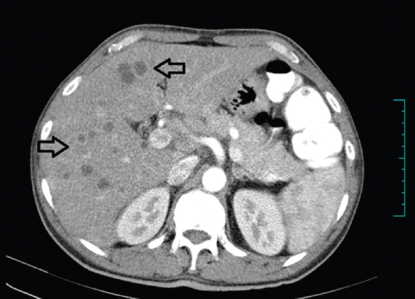 Computed tomography abdomen image with liver showing multiple hypodense (marked with hollow arrows) lesion with subtle peripheral enhancement and splenomegaly.